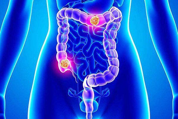 افزایش سرطان روده بزرگ در ایران ، علائم آن را بشناسید افزایش سرطان روده بزرگ در ایران ، علائم آن را بشناسید