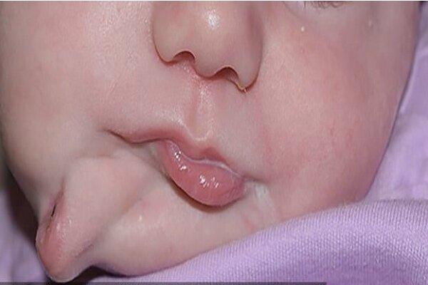 نوزادی با دو دهان به جهان آمد، جراحی موفقیت آمیز دهان اضافه