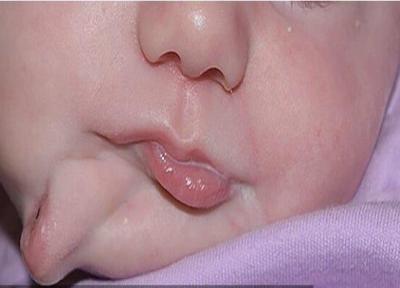 نوزادی با دو دهان به جهان آمد، جراحی موفقیت آمیز دهان اضافه