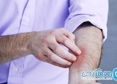 آیا استرس می تواند باعث بروز کهیر گردد؟
