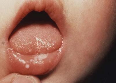 برفک دهان نوزاد را باید جدی بگیریم؟ درمان آن چیست؟