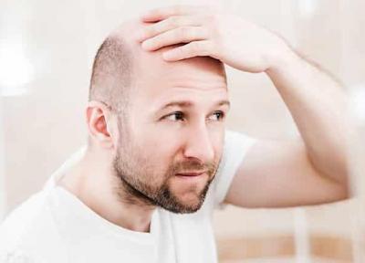 روش های کاشت مو با بانک موی ضعیف کدامند؟
