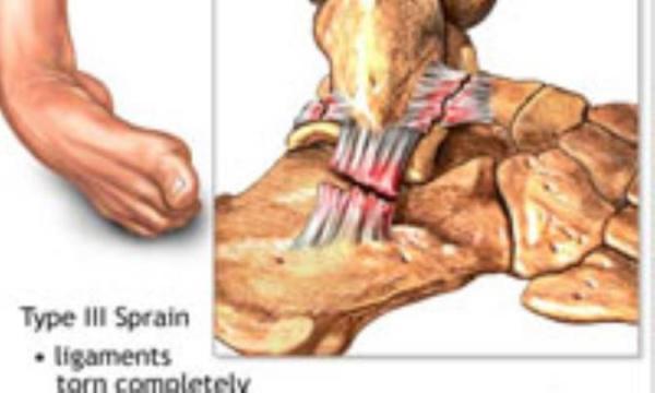 کمک های اولیه پیچ خوردگی مچ پا