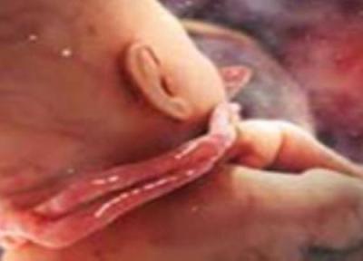 بند ناف در اطراف گردن کودک در رحم